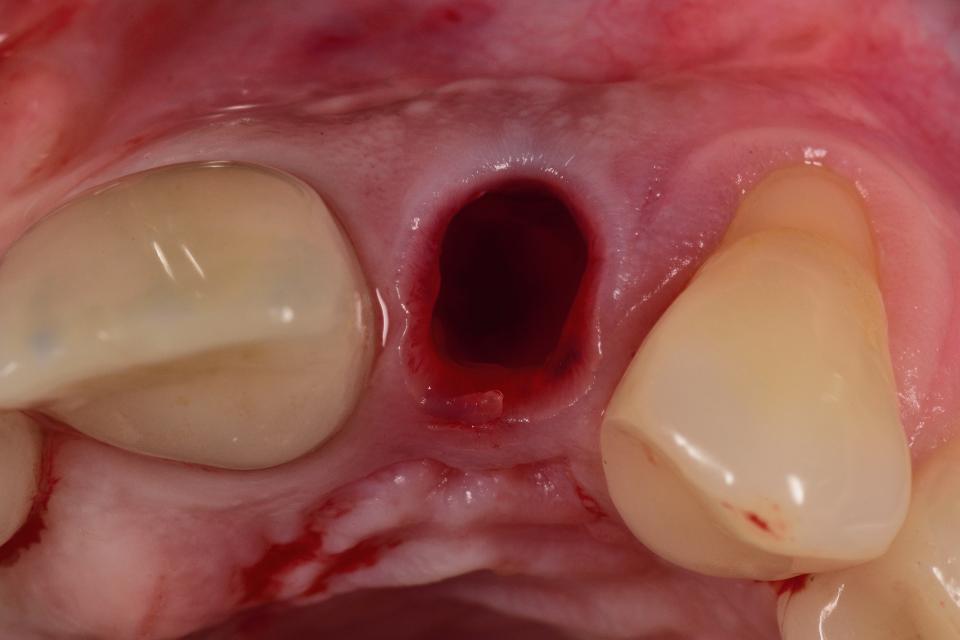 Fig. 44: Tooth extraction without flap elevation