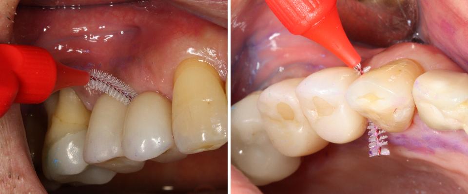 Fig. 7c: Les protocoles de soins péri-implantaires de maintenance doivent être adaptés à chaque patient et peuvent inclure des conseils d'hygiène bucco-dentaire démontrant l'utilisation d'une brosse interdentaire pour l'élimination de la plaque.