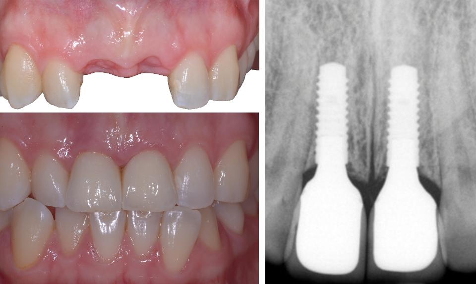 Resim. 2: Üst sol: Komşu dişlerde minimal ataşman kaybının olduğu eksik maksiller santral kesicilerin operasyon öncesi durumu. Radyografi implantlar arası ve komşu dişler arası gereken mesafenin dikkate alındığı ideal implant konumunu gösteriyor. Alt sol: Mevcut doğal dişlere ahenkle entegre olmuş final implant restorasyon