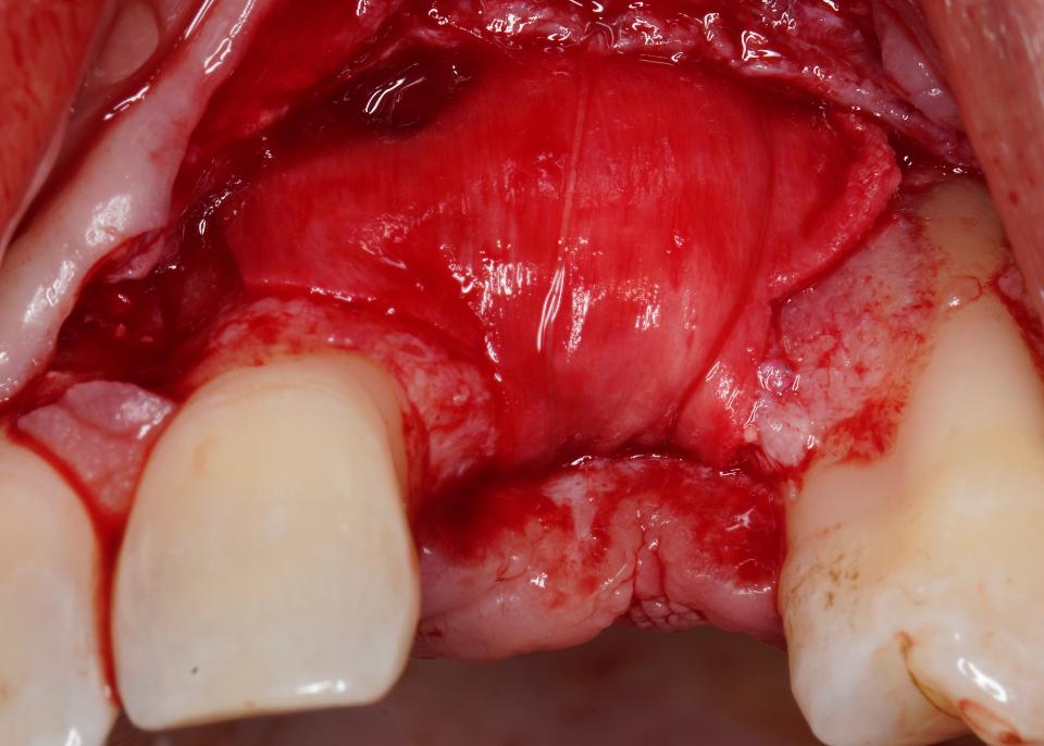 Fig. 4: La membrane est fixée à l'aide de sutures sous-périostées résorbables, secondées par des pins supplémentaires fixant la membrane à l'extrémité la plus apicale.