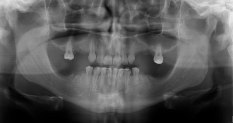 Fig. 3: Situation radiologique avant la greffe osseuse et la pose de l'implant.