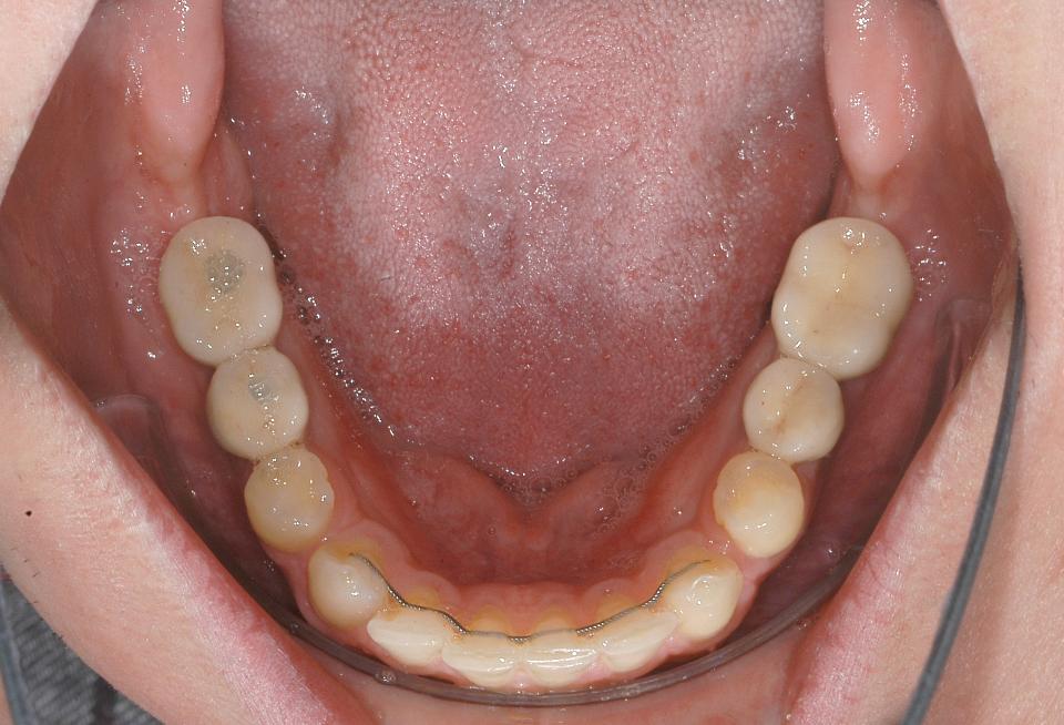 Şekil 6c: Hastanın diş eksikliklerinin implant destekli protetik restorasyonlar ile rehabilitasyonu: Mandibular oklüzal görünüm.