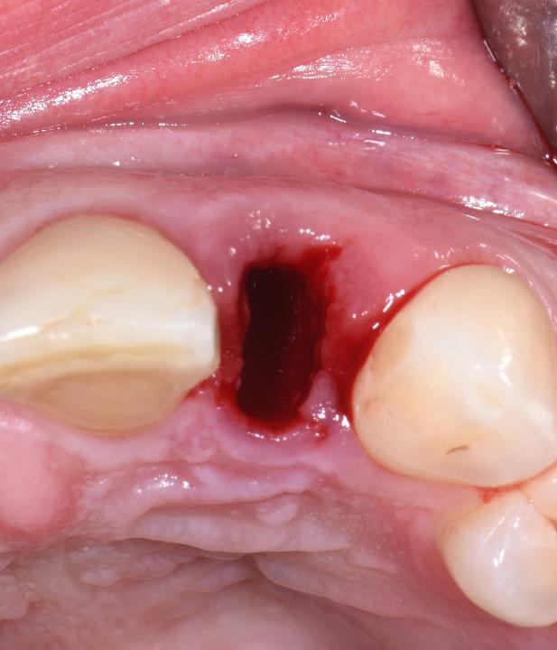 Fig. 2d: Following intracrevicular incisions, the tooth was carefully extracted using a combination of fine luxators and forceps. It was confirmed that the facial socket bone was intact
