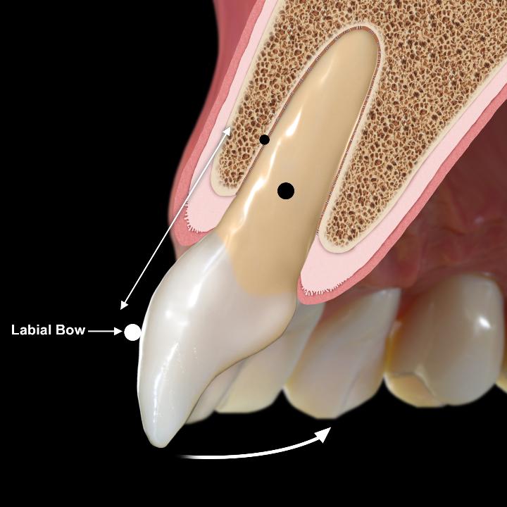 图3: 传统活动矫治器的加力模式，其特点是位于牙冠唇侧远离旋转中心的单个加力点，导致牙齿旋转移动