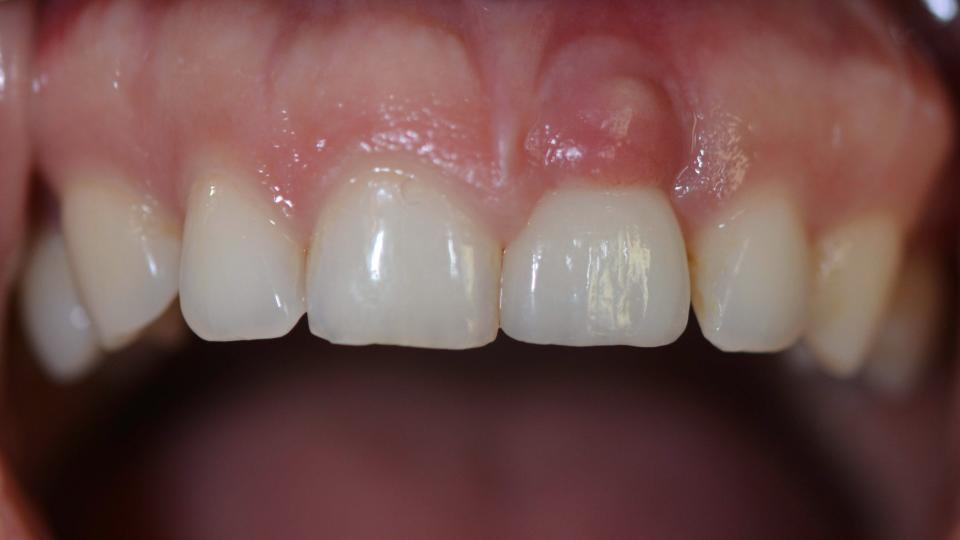 Figs 6a: Fratura do colo do implante com conexão cônica interna, inicialmente manifestada como inflamação periodontal e fístula. 