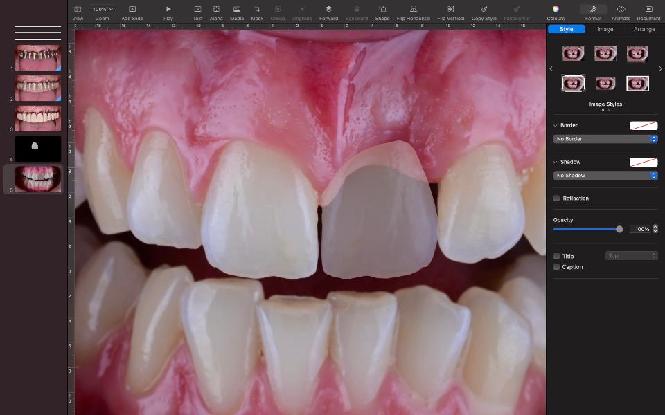 Fig. 13: Dente adjacente espelhado