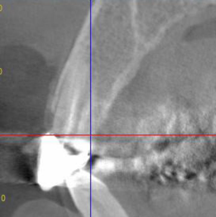 Fig. 5b: Cross-section CBCT view of the tooth confirmed the presence of an intact facial bone wall and absence of periapical pathology. There was sufficient apical bone to be able to place an implant and achieve stability