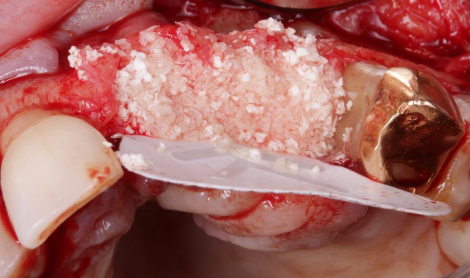 Abb. 12b: Horizontale und vertikale Knochentransplantation + Typ-4-Implantation: Einbringen eines partikulierten Knochentransplantats.
