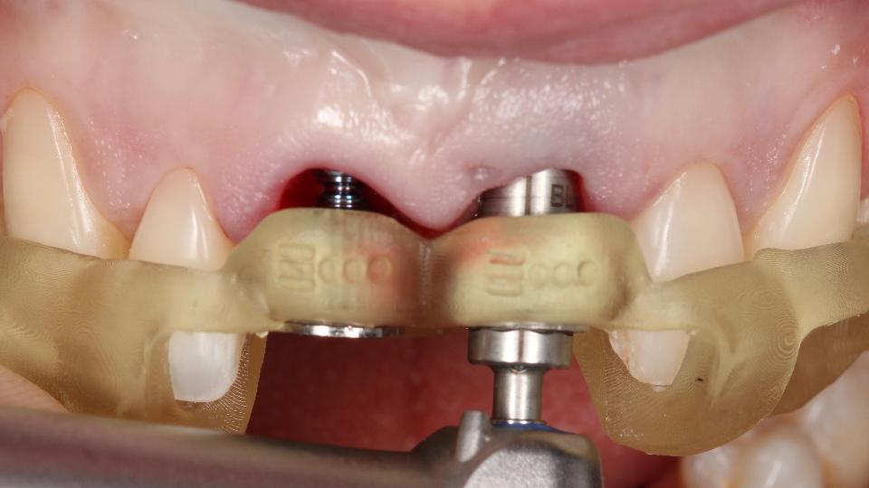 Fig. 5h: Utilización del protocolo totalmente guiado de cirugía de implantes asistida por ordenador estático para la colocación inmediata de implantes – región #21 – utilización del adaptador guiado para colocar el implante con la guía quirúrgica en posición