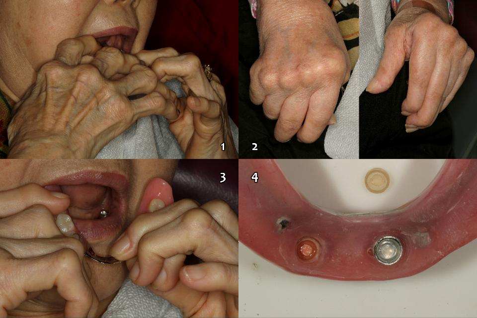 Fig. 17c: Which retainers should be chosen for patients with this type of finger disorder (1-3)? Frequent damage to silicone devices due to mishandling of the locator IOVD (4). Basically, prosthetic design and a retentive device should be considered that can be handled well not only by the elderly patients themselves but also by their caregivers or guardians (universal design, Leesungbok 2016)