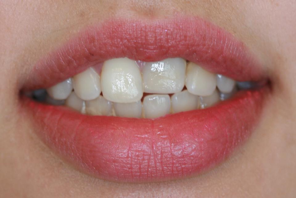 Abb. 8a: Erhalt des Alveolarkammes. Klinischer Befund bei einer 18-jährigen Patientin mit ankylosiertem Zahn 21 nach dessen Avulsion und der lateralen Luxation von Zahn 22