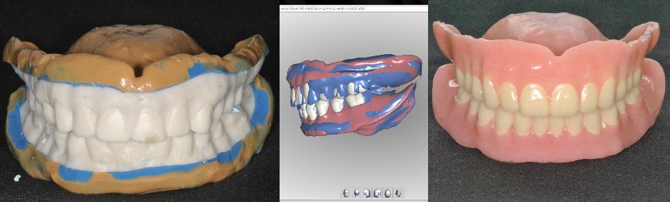 Figs 18a - c: Example of cost-effective option with a computer-aided workflow: complete copy denture using the AvaDent system. More processes are needed for the elderly patients of today and tomorrow that are light on the wallet and enable a more than adequate quality of life