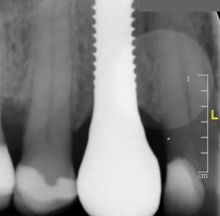 Fig. 4g: Imagen radiográfica 5 años después de la colocación del implante (Fotografía: Stefan Roehling)
