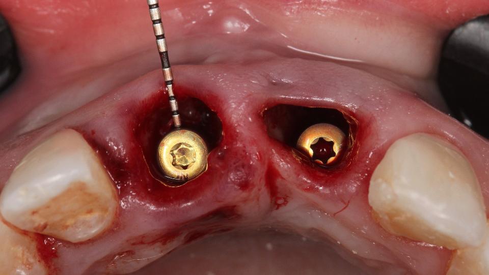 Fig. 6d: Type 1a protocol – region #11 – measurement of the distance between the implant surface and the facial bone wall (gap dimension) which is >2 mm