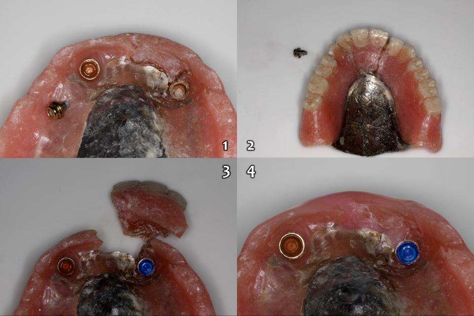 Fig. 10a: An 81-year-old patient referred from a local clinic wanted to have a new IOVD because the old IOVD became unusable due to fracturing. (1: 2-implant with 2-Locator and Locator abutment fracture; 2: fractured palatal aspect of the IOVD; 3: new silicone blue cap replaced on the left side of Locators; and 4: after temporary repair of the old IOVD)
