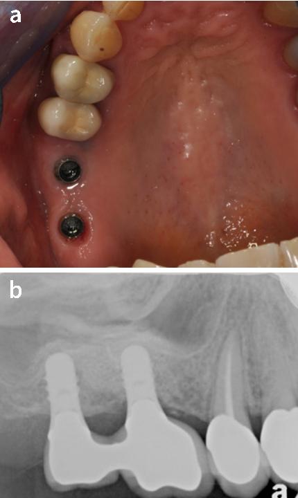 Fig. 4: The crown was removed, and a closure screw was placed on the implant, which was left in place. The patient was recalled on a monthly basis to ensure oral hygiene as well as to follow up on the clinical stability of the implant. Three months later, and as the implant returned an ISQ value of 78, an impression was taken (a) for the manufacture of two splinted crowns, which were placed and torqued down with 35 Ncm (b) without any spinning, movement, or discomfort, suggesting that re-osseointegration of the implant 16 had been achieved