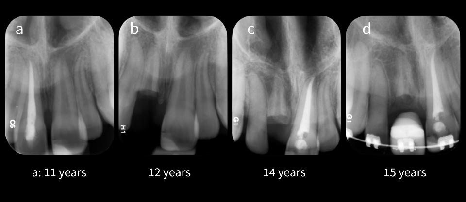 图6: 截冠。一位男孩的根尖片，他10岁时，12、11和21牙脱位损伤。a:  11岁时的根尖片，11行根管治疗; b:  12岁时。11牙下沉且叩诊时出现高调金属音，诊断为牙固连。进行截冠术，包括去除根管充填物; c: 14岁时。牙槽骨连续垂直向生长至11牙根冠方。可见12牙髓腔闭塞，21牙已行根管治疗; d:  15岁时。可见11牙根发生骨替代
