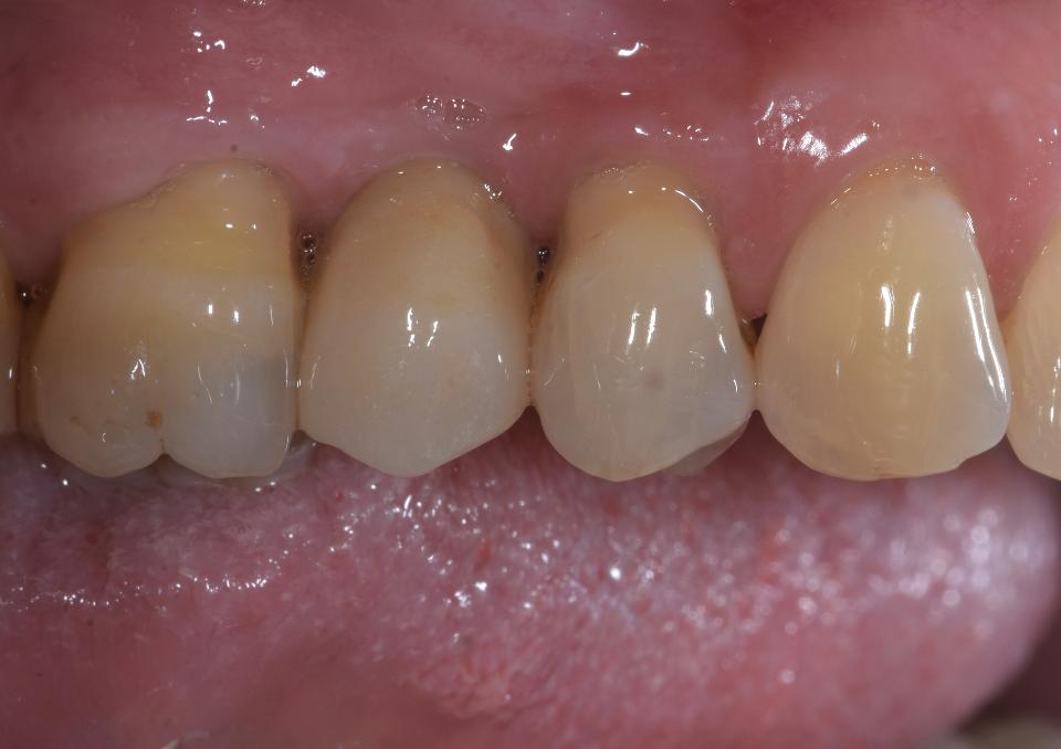 Fig. 3b: 右側上顎第二小臼歯（5┘歯）部のモノリシックインプラント支持ジルコニアクラウンの側面観