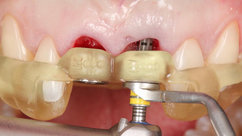 Fig. 5e: Uso del protocollo di chirurgia implantare statico-computerizzata completamente guidata per l'inserimento immediato dell'impianto – regione #21 – seconda fresa (ø2,8 mm) durante la preparazione dell'osteotomia