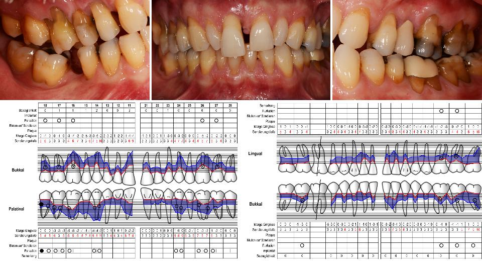 Fig. 4a: Fotografías de inicio y tabla periodontal