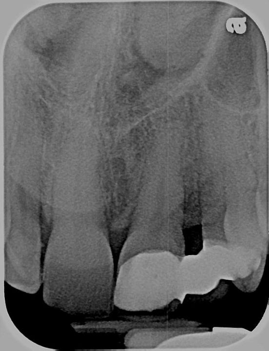 Fig. 6: Imagem radiográfica do mesmo caso mostra espaço interradicular inadequado para a colocação do implante, necessitando de tratamento ortodôntico para paralelismo radicular.