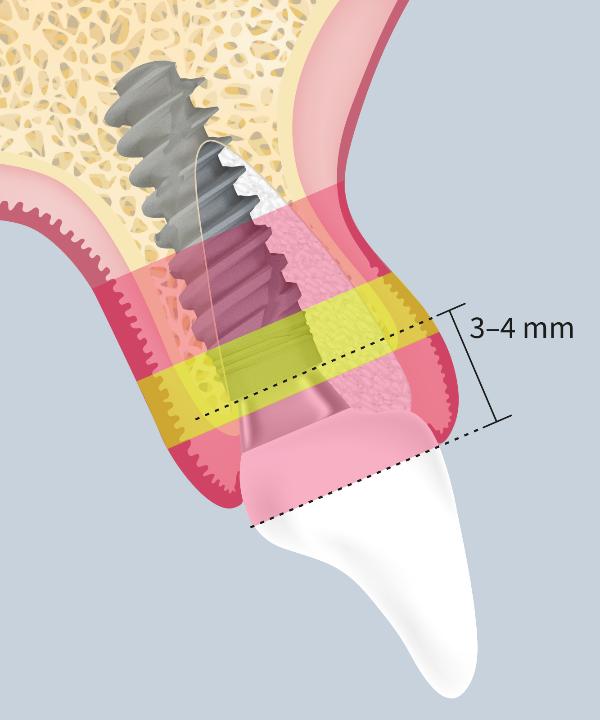 Abb. 4a: Ideale dreidimensionale Implantatposition – die Implantatschulter sollte 3–4 mm apikal des mukosalen Restaurationsrands, aber unterhalb des palatinalen Knochensaums liegen (mit frdl. Genehmigung von Lambert et al. 2023)