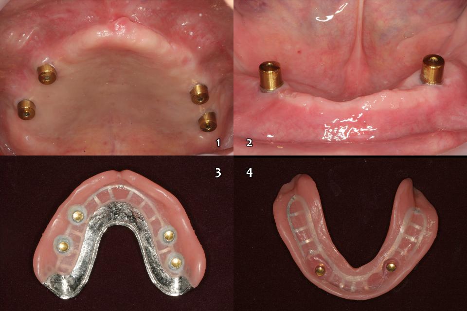 Fig. 13a: 2-4 implants magnetic overdenture can be provided for the upper and lower edentulous jaw with magnetic attachments (Magfit-DX800, Single-standing & Dome-top abutment keeper, Aiichi Steel) which can rotate slightly during function while maintaining a magnetic force of 800 gf (1 - 4)