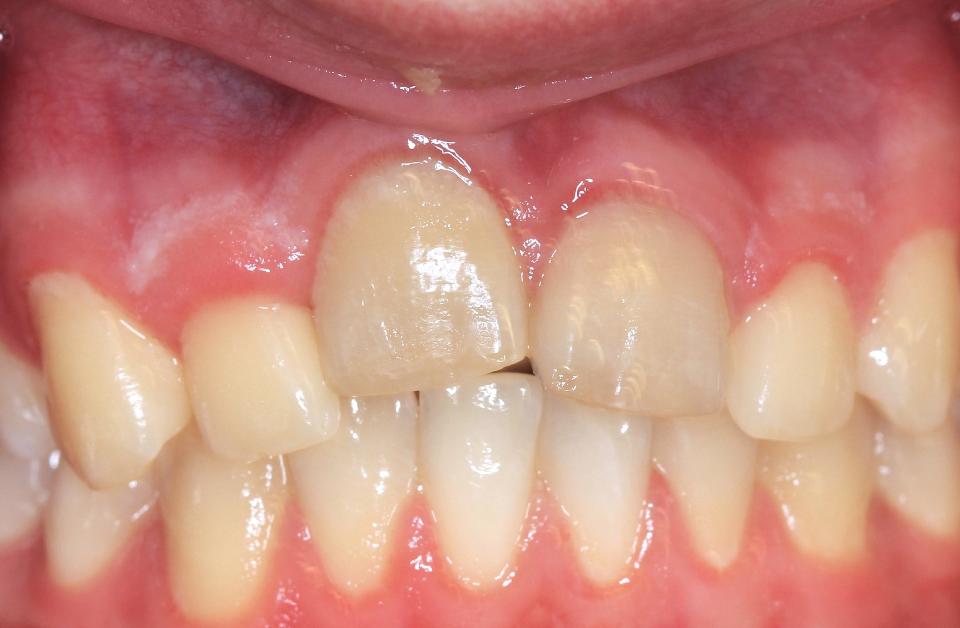 Fig. 4a: Anquilose. Apresentação clínica de incisivos centrais superiores direitos anquilosados: a infraposição levou à inclinação dos dentes adjacentes em direção ao dente anquilosado.