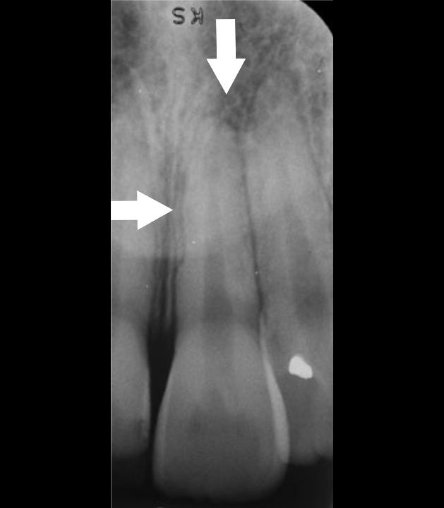图1: 表面愈合吸收。左上中切牙根尖片。可见牙根近中因表面愈合吸收导致根面不规则，但牙周膜间隙完好