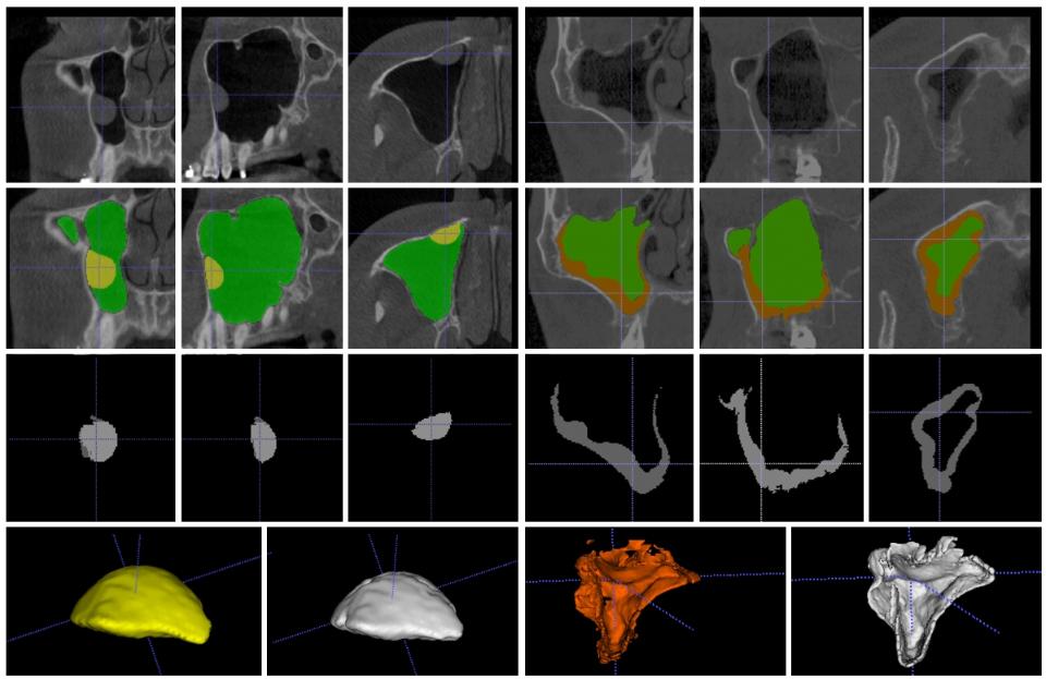 Fig. 6: Un ejemplo de segmentación automatizada basada en IA de un quiste de retención mucosa y engrosamiento mucoso en los senos maxilares derechos de dos pacientes en imágenes CBCT utilizando el modelo de aprendizaje profundo de Hung et al. (Hung, Ai, et al. 2022). La fila superior muestra las imágenes CBCT originales. La segunda fila muestra las imágenes CBCT con el espacio aéreo del seno segmentado manualmente (área verde), el quiste (área amarilla) y el engrosamiento de la mucosa (área naranja). La tercera fila muestra la segmentación automatizada del quiste y el engrosamiento de la mucosa (área gris). La fila inferior muestra imágenes de volumen que ilustran el quiste y el engrosamiento de la mucosa segmentados manualmente (área amarilla/naranja) y automáticamente (área blanca)