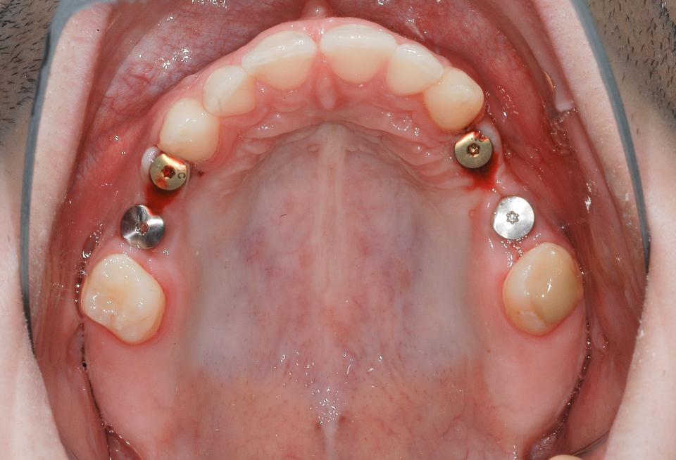图4b: 种植体植入后的临床状况：上颌合面照