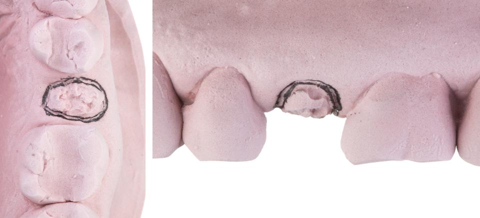 Fig. 3d: The pre-operative cast with the gingival margin of the tooth to be extracted outlined
