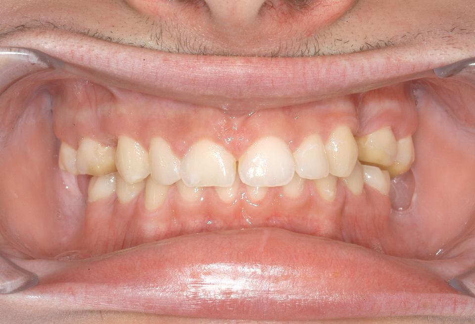 Fig. 2a: Situazione clinica iniziale di un paziente maschio di 19 anni con displasia ectodermica e assenza di denti multipli: Vista frontale