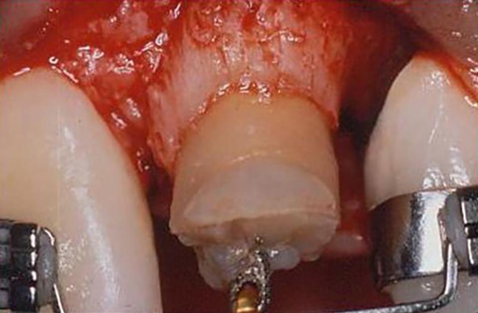 Şekil 8: Sürdürme sonrası alveolar kret üzerindeki etkisini gösteren klinik fotoğraf. Kalsifikasyon için yeterli bir sürenin ardından bir flep kaldırıldığında, kret kemiğinin insizalde ortodontik uyarana yanıt olarak sert doku değişikliği göstermesi ile kanıtlandığı gibi, krestal kemiğin ortodontik gerilime tepkisi ortaya çıkmaktadır.