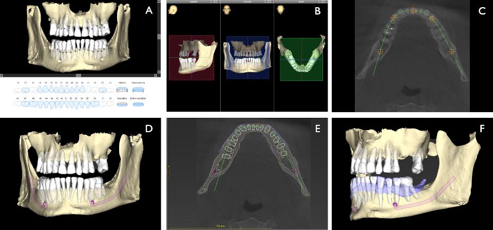 Fig. 4: Exemplo de preparação automatizada de TCFC usando o assistente de IA do software de planejamento de implantes CoDiagnostiX. A: vista 3D da segmentação automatizada dos dentes e da maxila/mandíbula; B: orientação 3D automatizada da TCFC; C: vista transversal da TCFC da definição da curva panorâmica automatizada por IA para a mandíbula; D: vista 3D da segmentação do NAI pelo assistente de IA; E: vista transversal da TCFC de todas as estruturas anatômicas segmentadas automaticamente (dentes, NAI, osso) e da impressão digital STL sobreposta; F: vista 3D da TCFC acionada pelo assistente de IA e da sobreposição STL