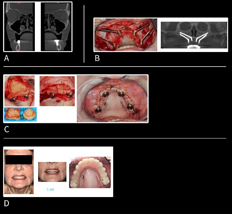 Fig. 16: Uso de membranas de FRP estendidas durante um caso de implante zigomático de arco completo. (A) Imagens de TCFC demonstrando seios totalmente pneumatizados com altura óssea residual mínima (RBH). (B) Colocação de 4 implantes zigomáticos com exposição significativa dos implantes. (C) Fabricação de várias membranas de FRP estendidas (e-FRP) utilizadas para cobrir os implantes. (D) Uma semana após a operação, demonstrando excelente cicatrização e baixa inflamação pós-operatória devido à consistência autóloga natural do material. Esses casos estão sendo acompanhados atualmente um ano após a cirurgia com excelente sucesso clínico até agora, sem a necessidade de uso de uma membrana de barreira de colágeno. (Caso realizado pelo Dr. Michael A Pikos; reimpresso com permissão de Miron 2021).