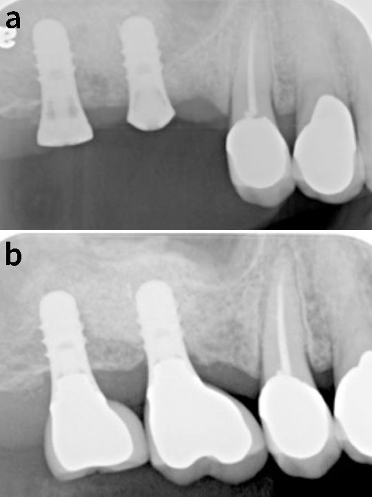 图2: 女性，61岁，不吸烟，全身健康，无磨牙或口内副功能史。16、17牙位植入两颗SP Straumann种植体(RN 4.1 mm x 10 mm)，同时进行了侧壁开窗的上颌窦提升手术(a)。种植体植入8个月后，使用两颗螺丝固位单冠进行修复，加力扭矩为35 Ncm (b)