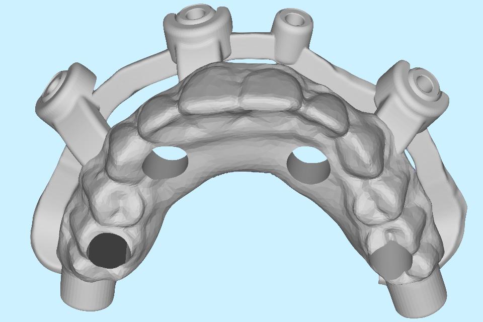 Fig. 25: Example STL file representing a surgical template and complete dental prosthesis for s-CAIS