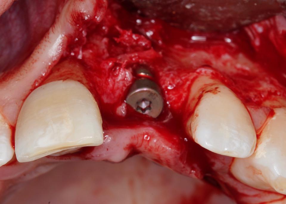 Fig. 2: Defecto de dehiscencia vestibular presente en el momento de la colocación del implante
