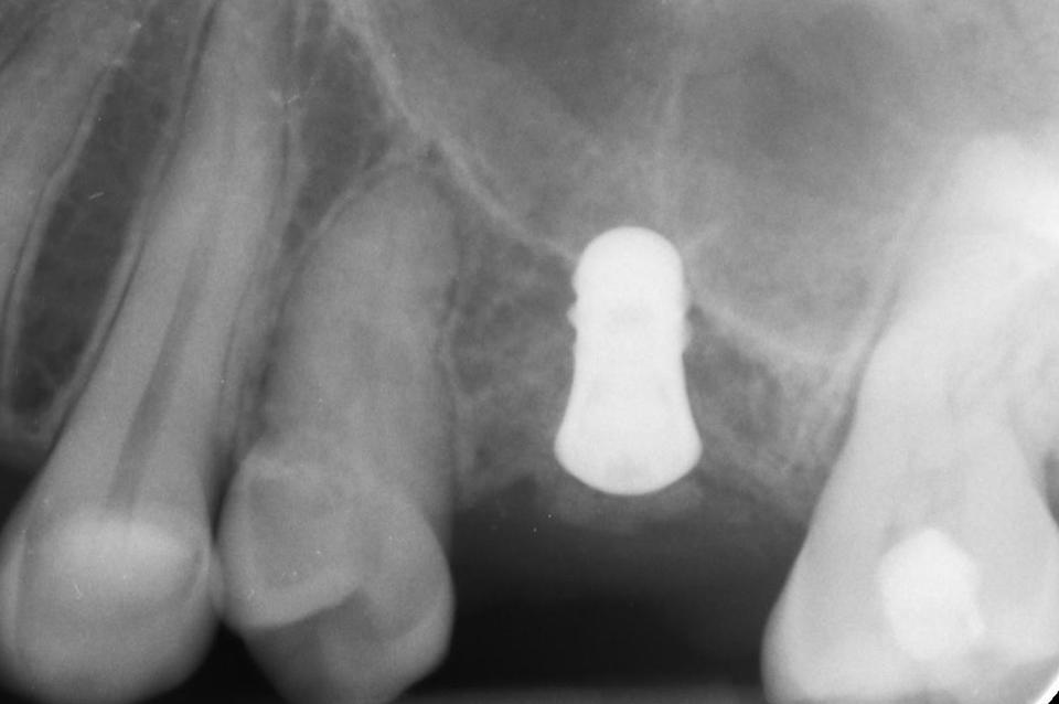 Fig. 5b-5: Short (4-mm) implant placed with simultaneous guided bone regeneration to compensate for the bone deficiency of the buccal side