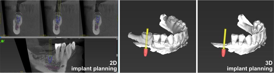 Fig. 6: Two-dimensional implant positioning in cross-sections and three-dimensioal verification of the implant position with and without prosthetic set-up