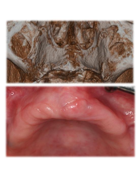 Fig. 1: Clinical picture and 3D x-ray of highly atrophic mandible