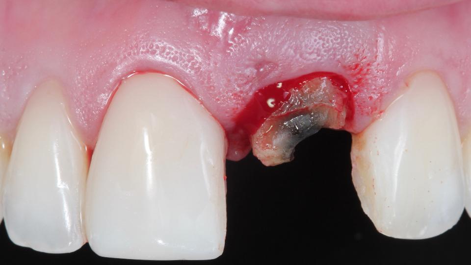 Fig. 2c: Tecnica mininvasiva per l'estrazione del dente senza lembo – dopo la rimozione della corona e l'uso di periotomi e delicati elevatori per facilitare la lussazione della radice