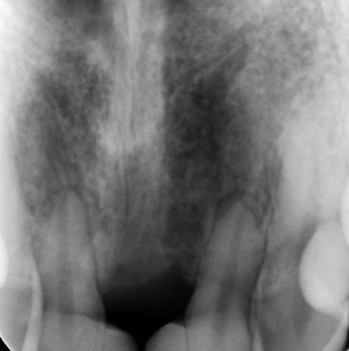 图5d: 正畸关闭间隙。冠修复后的根尖片。可见12、22牙根严重再吸收，从而不能向近中移动到正确的中切牙位置。因此，后期的全瓷冠修复设计也受到了影响