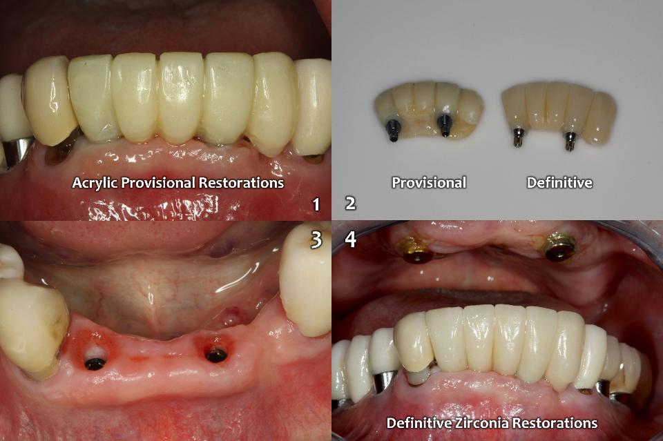 Fig. 10i: From the immediate provisional restorations after implant surgery to the definitive zirconia restoration by CAD/CAM workflow (Prettau, Zirkonzahn, Gais) on 2 implants (BLT, 2.9x12, NC, Roxolid, SLActive, Straumann)