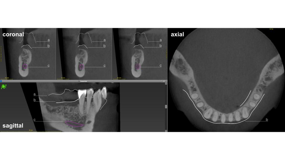 Fig. 2: Two-dimensional visualization of the CBCT in coronal, sagittal and axial cross-sections. a) diagnostic set-up; b) outline of the soft tissue; c) mandibular canal