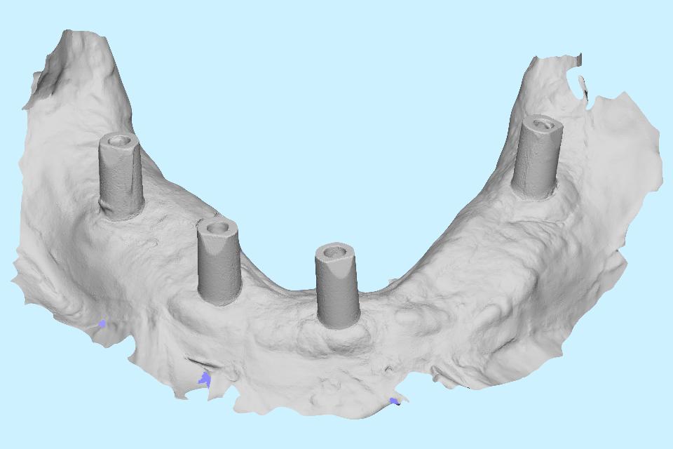 Fig. 24: Example STL file representing a mandibular intraoral scan of 4 dental implant scan bodies