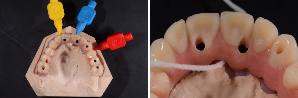 Figs 14a - b: Facilitated oral hygiene is a crucial component of geriatric dentistry. The restorations shown here are very demanding of patients and should only be realized in this form if the patient is still able to handle fine oral hygiene tools