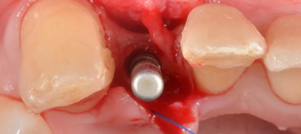 Fig. 10c: The effectiveness of narrow diameter implants relies on the adequate adjustment of occlusion to minimize biomechanical overloading. These can be considered a predictable minimally invasive alternative to preserve the critical buccal bone wall thickness