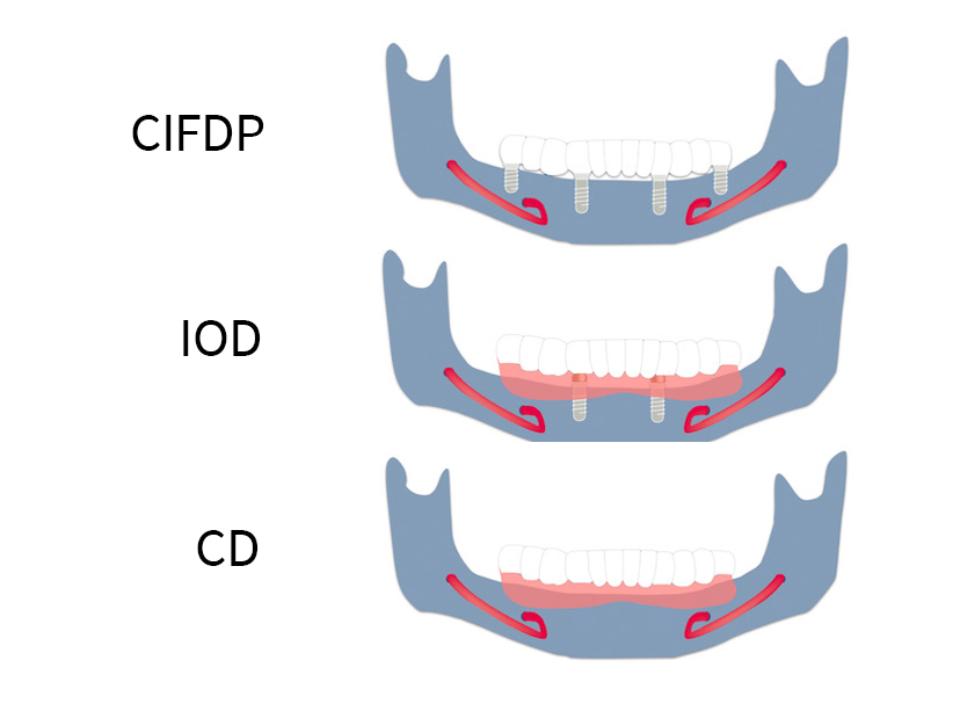 Fig. 5: Opciones de tratamiento convencionales e implantosoportadas en maxilares totalmente desdentados